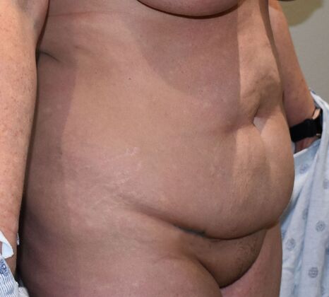 Tummy Tuck (Abdominoplasty): Case 361 - Before