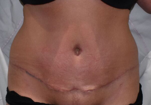 Tummy Tuck (Abdominoplasty): Case 361 - After