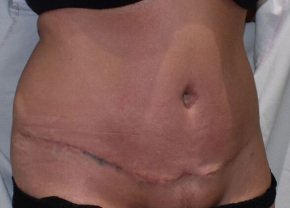 Tummy Tuck (Abdominoplasty): Case 361 - After