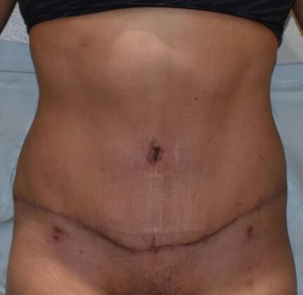 Tummy Tuck (Abdominoplasty): Case 362 - After