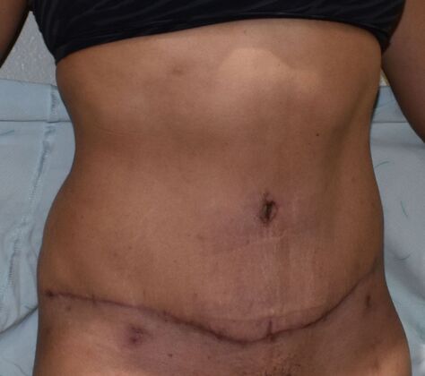 Tummy Tuck (Abdominoplasty): Case 362 - After
