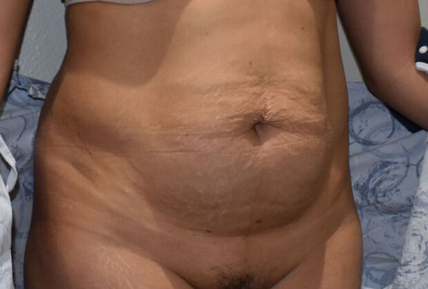 Tummy Tuck (Abdominoplasty): Case 362 - Before