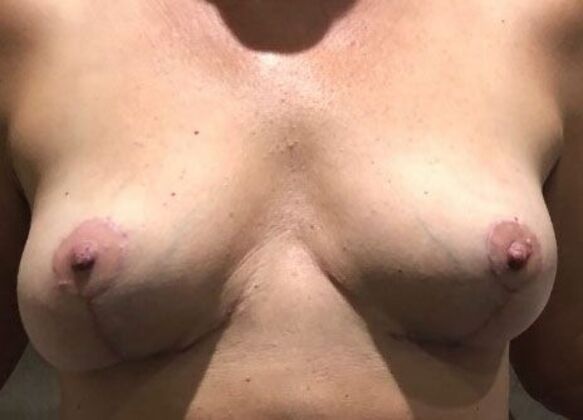 Breast Implant Removal: Case 16 - After