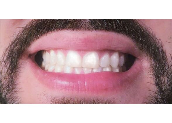 Dental Bonding - Teeth Bonding : Case 5- Broken Tooth Bonded, Dental Accident - After