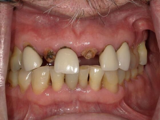Dental Crowns Case 3 - Before