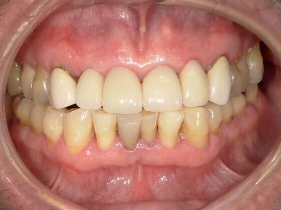 Dental Crowns Case 3 - After