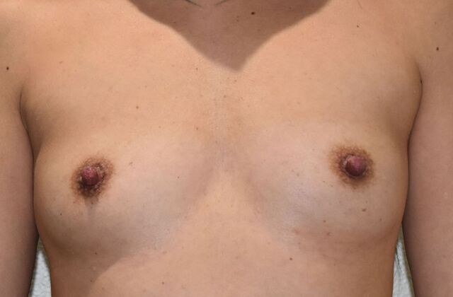 Breast Augmentation Case 704 - Before