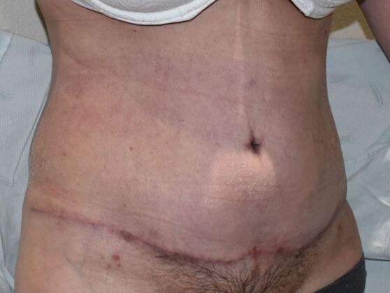 Tummy Tuck (Abdominoplasty): Case 364 - After