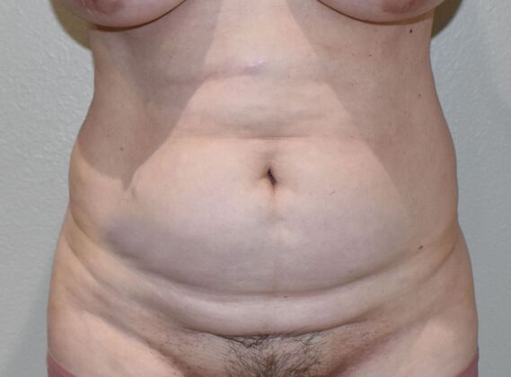 Tummy Tuck (Abdominoplasty): Case 364 - Before
