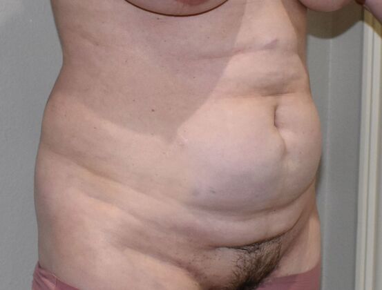 Tummy Tuck (Abdominoplasty): Case 364 - Before