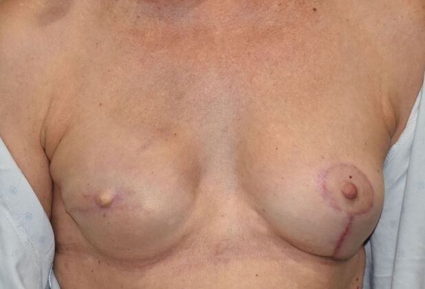 Breast Reconstruction Case 76 - After