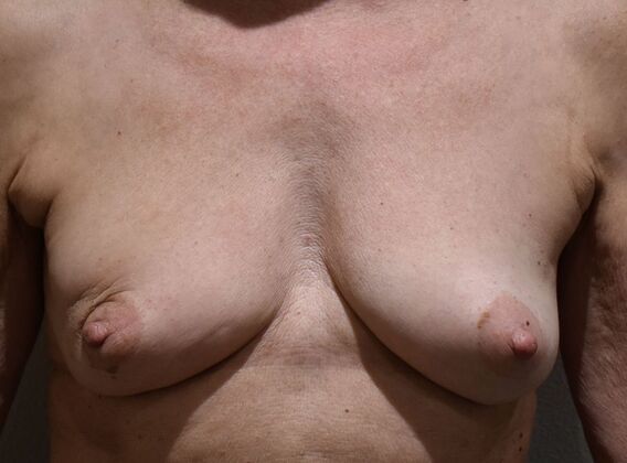 Breast Reconstruction Case 76 - Before