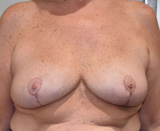 Breast Lift (Mastopexy) Case 142 - After
