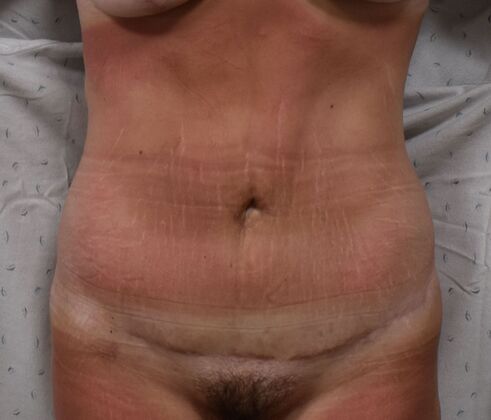 Tummy Tuck (Abdominoplasty): Case 365 - After