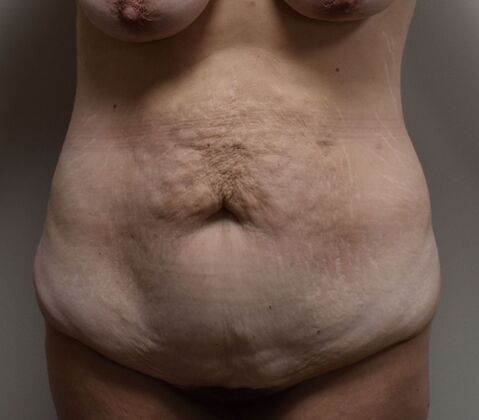 Tummy Tuck (Abdominoplasty): Case 365 - Before
