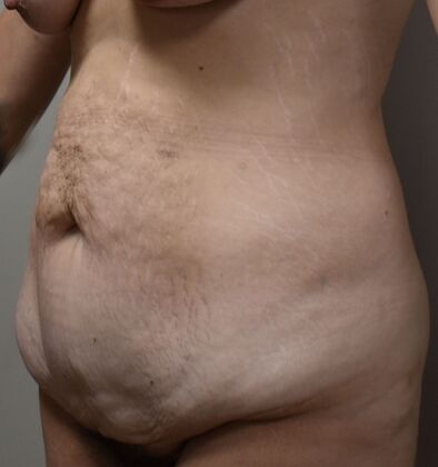 Tummy Tuck (Abdominoplasty): Case 365 - Before