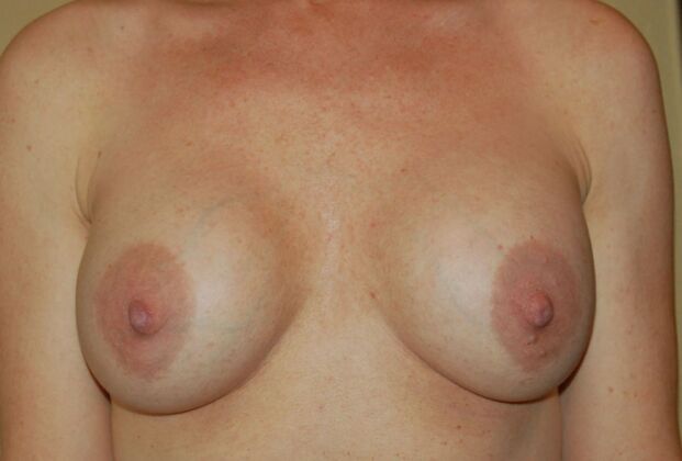 Breast Revision: Case 197 - Before