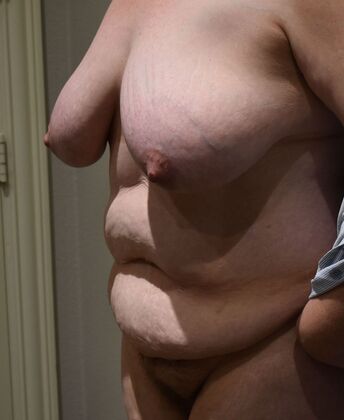 Massive Weight Loss : Case 105 - Before