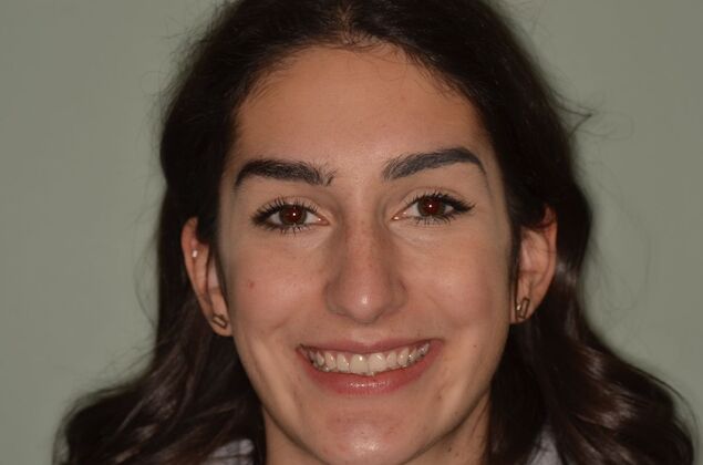 Invisalign: Case 21 - Before