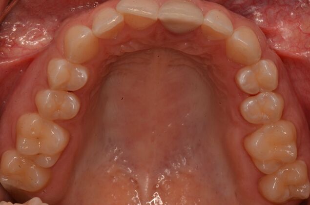 Invisalign: Case 21 - Before