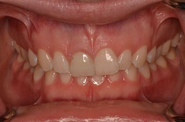 Invisalign: Case 21 - Before