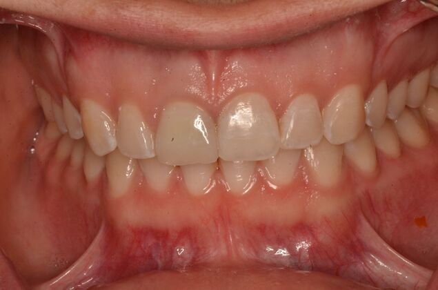 Invisalign: Case 21 - After