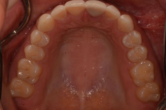 Invisalign: Case 21 - After