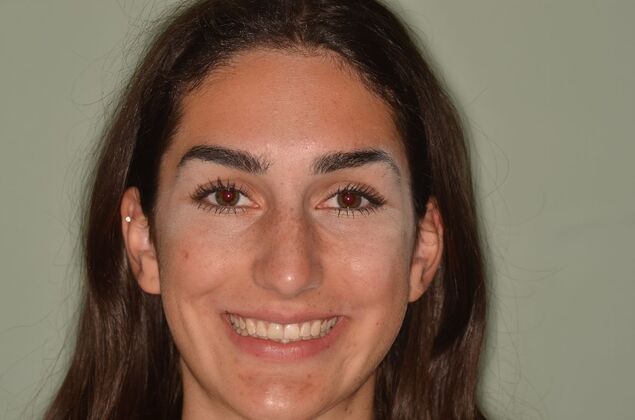 Invisalign: Case 21 - After