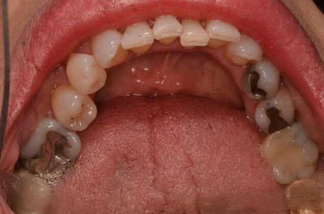 Invisalign: Case 22 - Lower teeth before invisalign