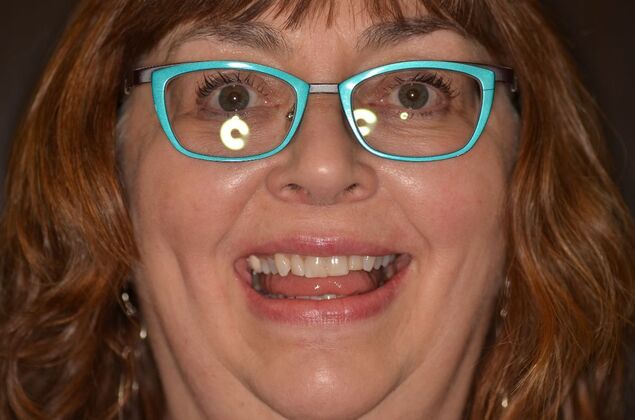 Invisalign: Case 22 - Before