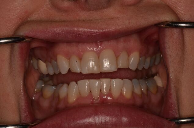 Invisalign: Case 22 - Before invisalign