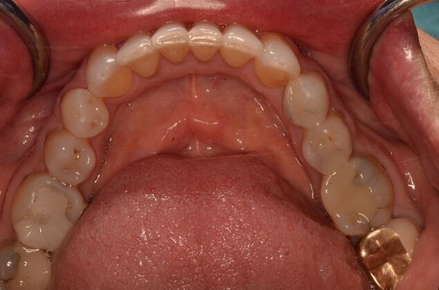 Invisalign: Case 22 - Lower teeth after invisalign