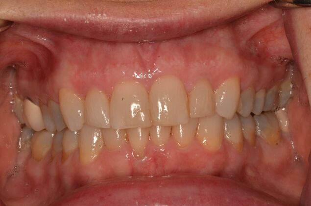 Invisalign: Case 22 - After invisalign (orthodontics)
