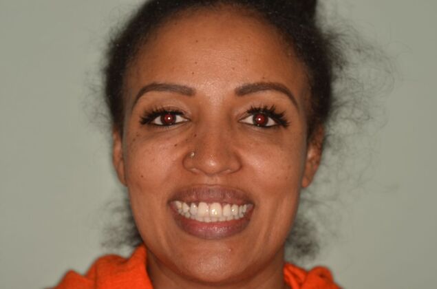 Invisalign: Case 23 - Before invisalign and two implants