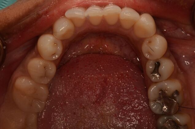 Invisalign: Case 23 - Before invisalign