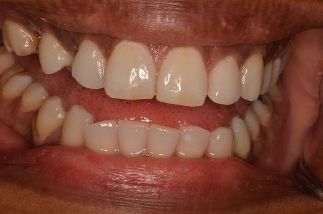 Invisalign: Case 23 - Before with crooked teeth