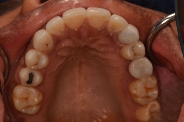 Invisalign: Case 23 - After invisalign and implants