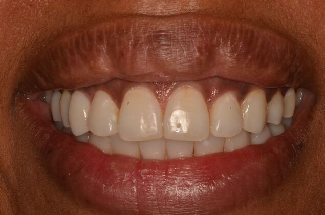 Invisalign: Case 23 - After invisalign and two implants