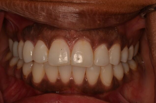 Invisalign: Case 23 - After invisalgin with straight teeth