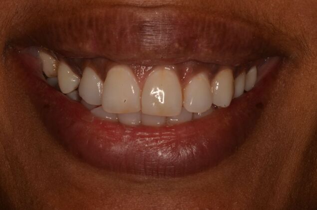 Dental Implants Case 57 - Before