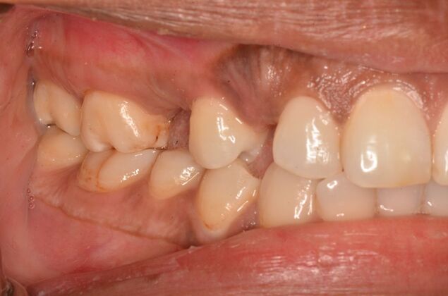 Dental Implants: Case 57 - Before invisalign and two implants