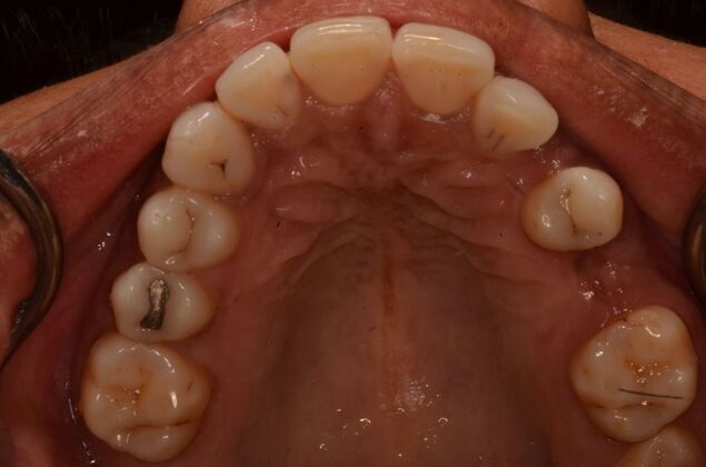 Dental Implants: Case 57 - Before invisalign and two implants