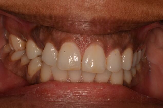 Dental Implants: Case 57 - Before invisalign and two implants