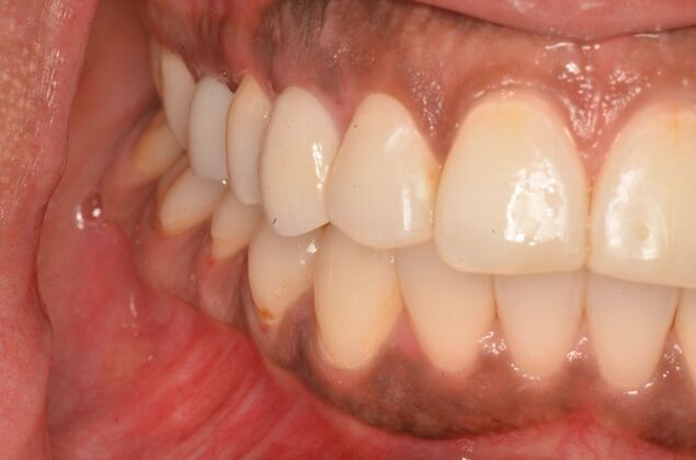 Dental Implants: Case 57 - After invisalign and two implants