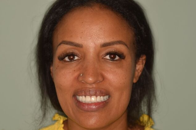 Dental Implants: Case 57 - After invisalign and implants