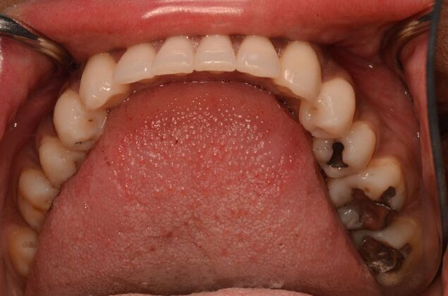 Dental Implants: Case 57 - After invisalign lower jaw