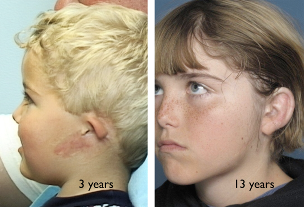 Injuries: Patient 1 - 3yr. old boy after a burn injury & 10yrs. later after reconstruction.