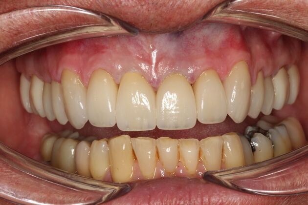 Full Mouth Rehabilitation Greg - After