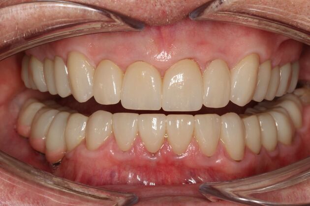Full Mouth Rehabilitation Horst - After