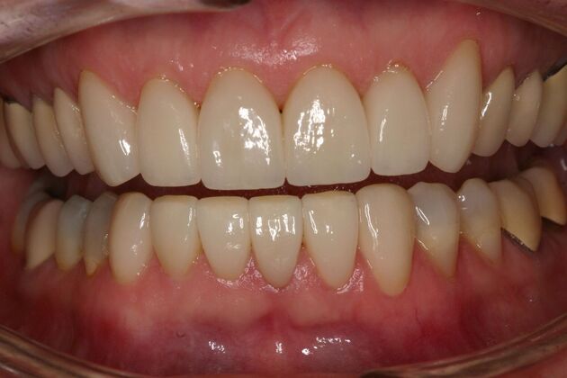 Veneers Pat - After